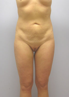 Thigh Lift Before & After Image