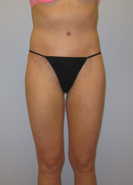 Thigh Lift Before & After Image