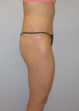 Thigh Lift Before & After Image