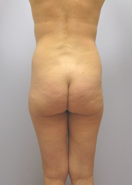 Thigh Lift Before & After Image