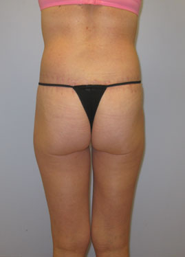 Thigh Lift Before & After Image