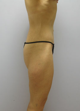 Thigh Lift Before & After Image