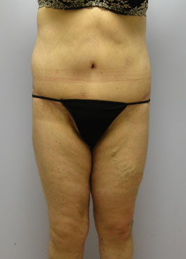 Thigh Lift Before & After Image