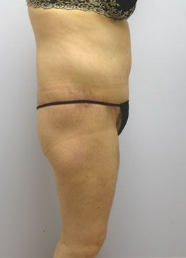 Thigh Lift Before & After Image