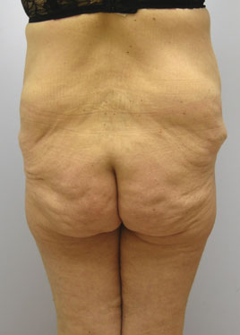 Thigh Lift Before & After Image