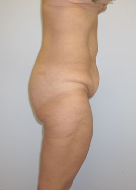 Thigh Lift Before & After Image