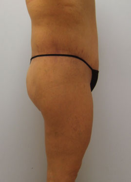 Thigh Lift Before & After Image