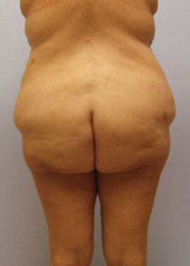 Thigh Lift Before & After Image