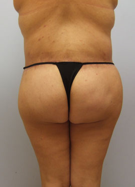 Thigh Lift Before & After Image