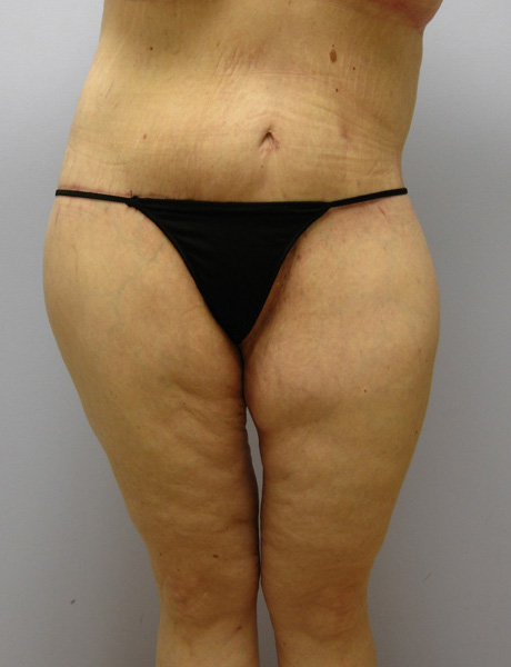 Thigh Lift Before & After Image