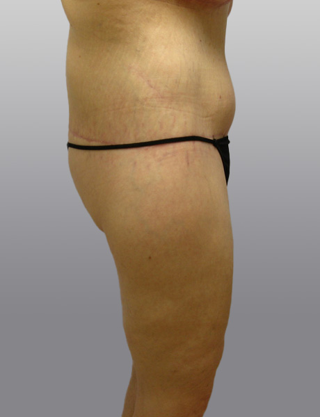 Thigh Lift Before & After Image