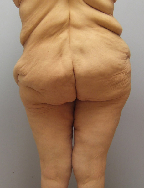 Thigh Lift Before & After Image