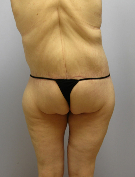 Thigh Lift Before & After Image