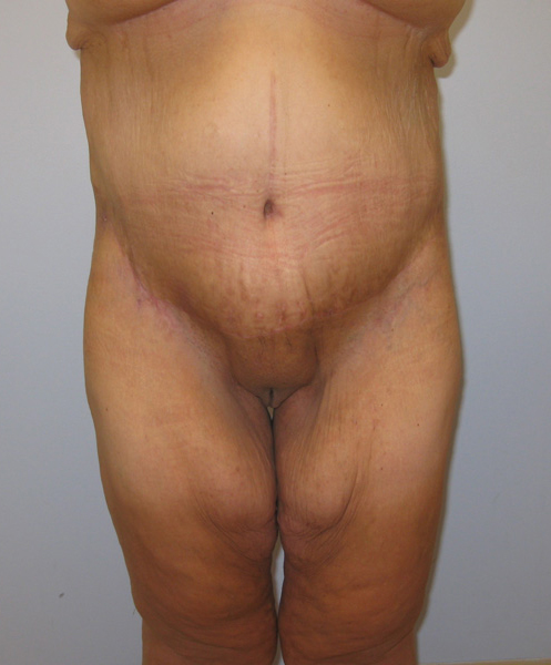 Thigh Lift Before & After Image