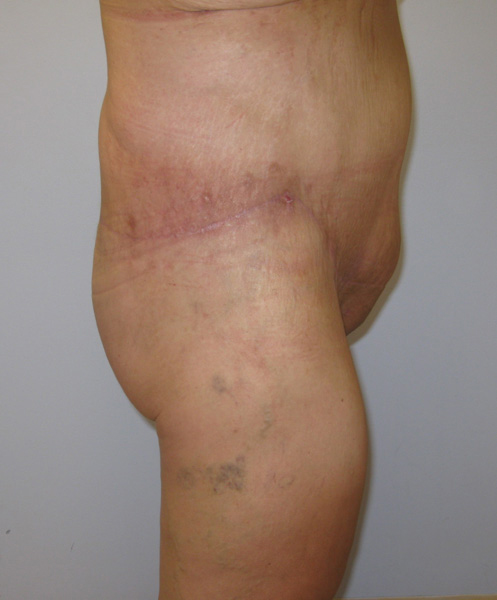 Thigh Lift Before & After Image