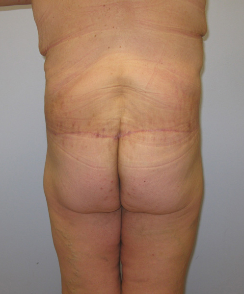 Thigh Lift Before & After Image