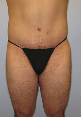 Thigh Lift Before & After Image