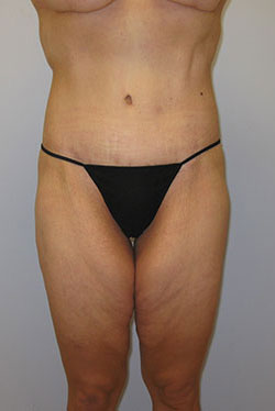 Thigh Lift Before & After Image