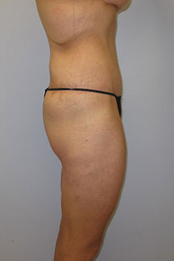 Thigh Lift Before & After Image