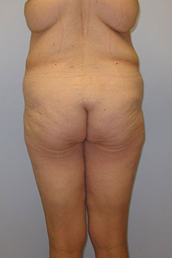 Thigh Lift Before & After Image