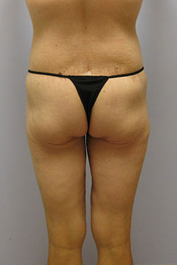 Thigh Lift Before & After Image