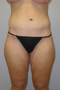 Thigh Lift Before & After Image