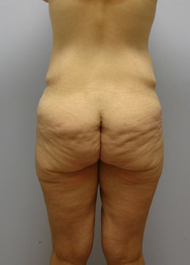 Thigh Lift Before & After Image