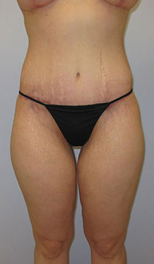 Thigh Lift Before & After Image