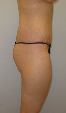 Thigh Lift Before & After Image