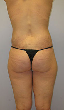 Thigh Lift Before & After Image