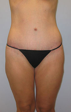 Thigh Lift Before & After Image