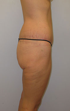 Thigh Lift Before & After Image