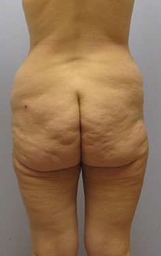 Thigh Lift Before & After Image