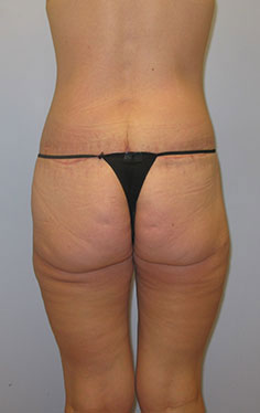 Thigh Lift Before & After Image