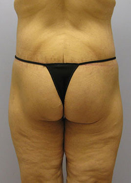 Thigh Lift Before & After Image