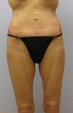 Thigh Lift Before & After Image