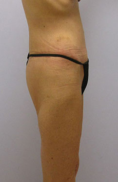 Thigh Lift Before & After Image