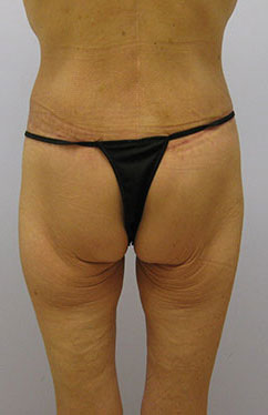 Thigh Lift Before & After Image