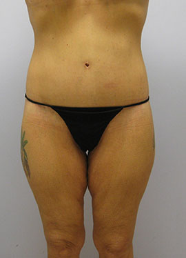 Thigh Lift Before & After Image