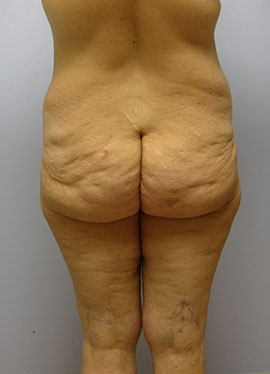 Thigh Lift Before & After Image