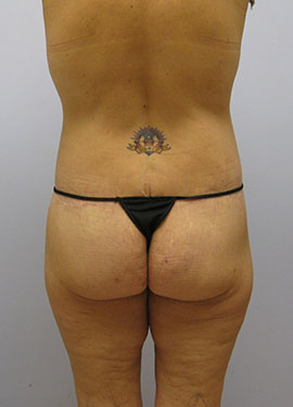 Thigh Lift Before & After Image