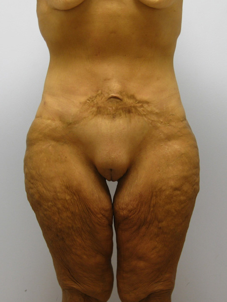 Thigh Lift Before & After Image