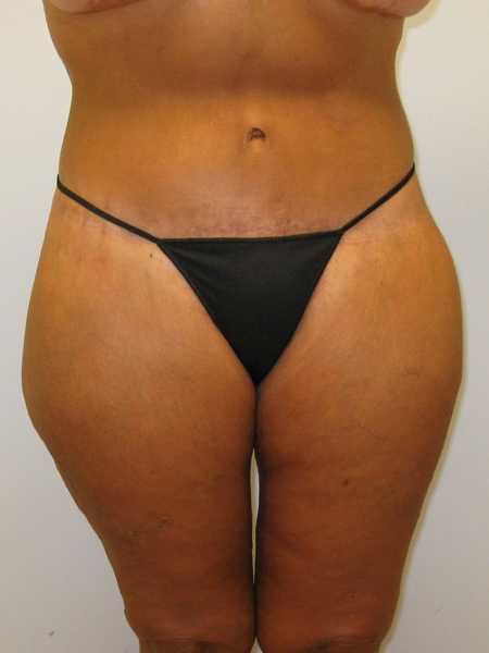 Thigh Lift Before & After Image