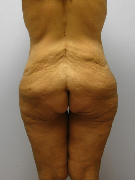 Thigh Lift Before & After Image