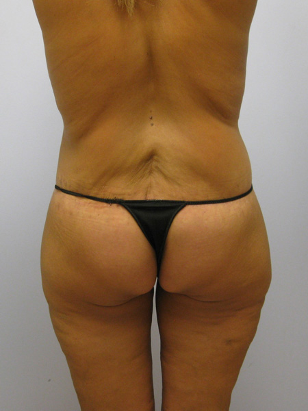 Thigh Lift Before & After Image