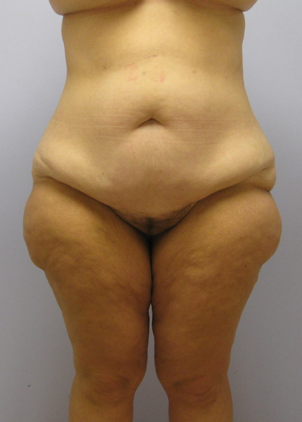 Thigh Lift Before & After Image