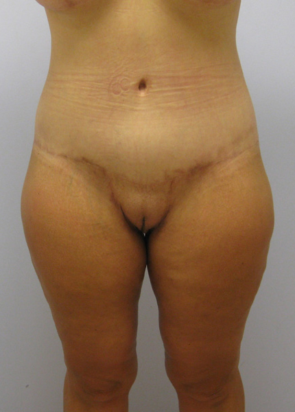 Thigh Lift Before & After Image