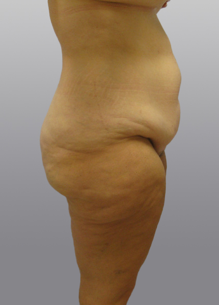 Thigh Lift Before & After Image