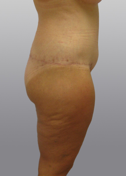 Thigh Lift Before & After Image