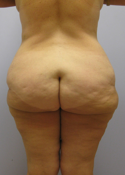 Thigh Lift Before & After Image